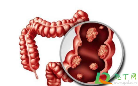 超9成大肠癌源于息肉癌变真的假的1