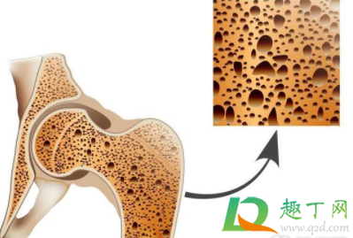 骨质疏松会导致骨折吗1