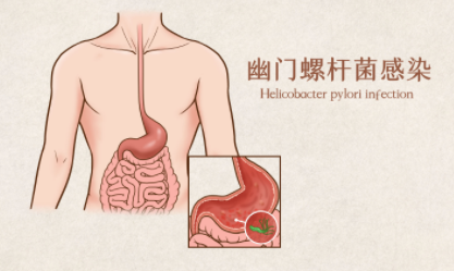 幽门螺旋杆菌为什么是致癌物