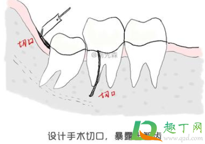 智齿横着长了拔掉难度大吗3