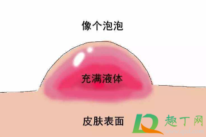 水泡怎么处理不痛4