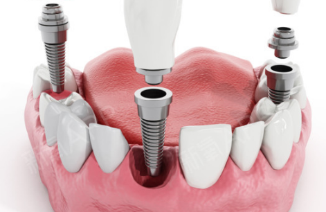 种植牙可能进医保吗3