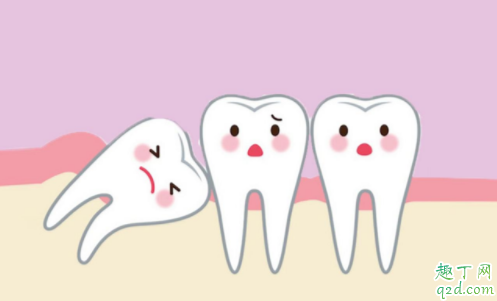 准备怀孕智齿一定要拔吗 准备怀孕有智齿但不痛需要拔吗
