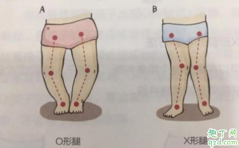 婴幼儿o型腿可以矫正过来吗 婴儿o型腿可以用绑带矫正吗2