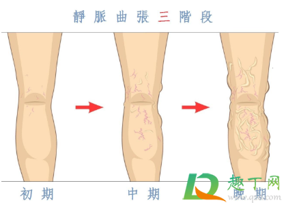 静脉曲张需不需要做手术2