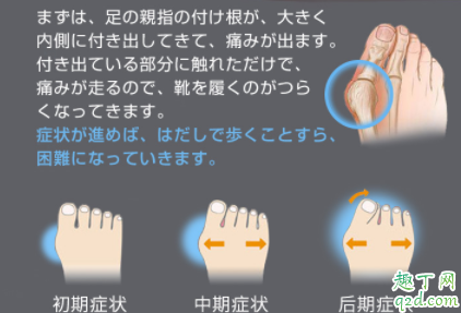 拇外翻矫正器有效果吗 拇外翻矫正器一天带多长时间3