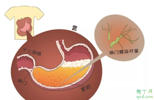 幽门螺杆菌感染会出现哪些症状 胃病是因为幽门螺杆菌吗1