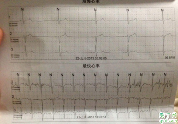 心律失常做什么检查确诊 心律失常是心跳快还是慢2