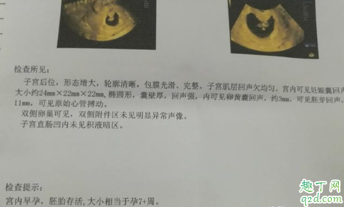 怀孕七周没有胎心什么原因 怀孕7周肚子有点隐痛怎么回事2