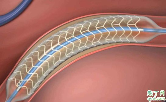心脏支架后为什么吃药 冠心病能不能不做支架3