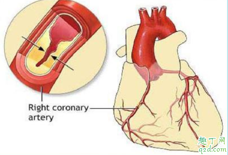 冠心病可以治疗除根吗 冠心病要做手术吗3