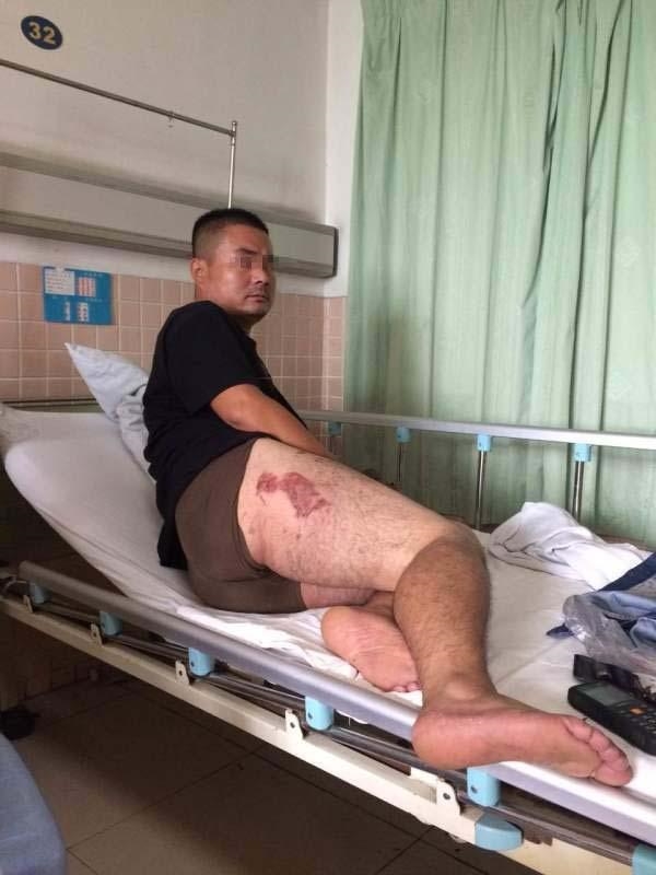 手机揣裤兜爆炸：男子大腿烧焦一大块