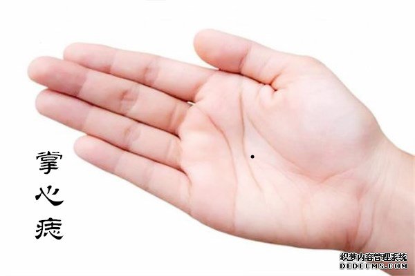 痣相分析：掌心有痣代表什么，掌心有痣的人性格如何？