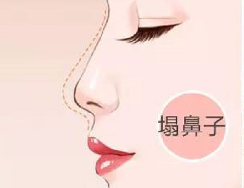 塌鼻梁面相分析：为您揭秘塌鼻梁人的性格与一生运势！