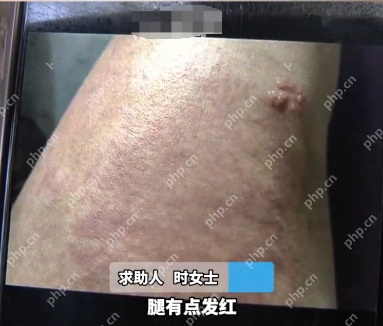 女子腿疼做理疗被烫伤无法下床 理疗馆反怼不知道躲 - 创想鸟