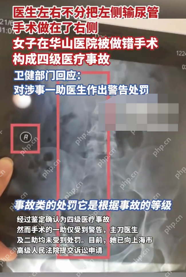 华山医院将左输尿管手术做成右侧是怎么回事？详情介绍 - 创想鸟