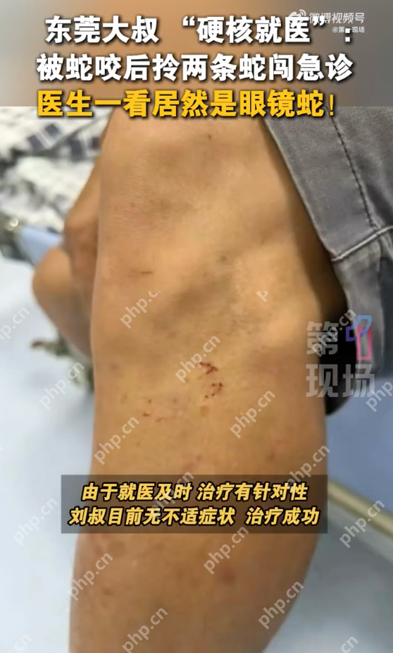 广东老人网鱼网到两条眼镜蛇被咬伤 被咬后手提2条眼镜蛇进急诊 - 创想鸟