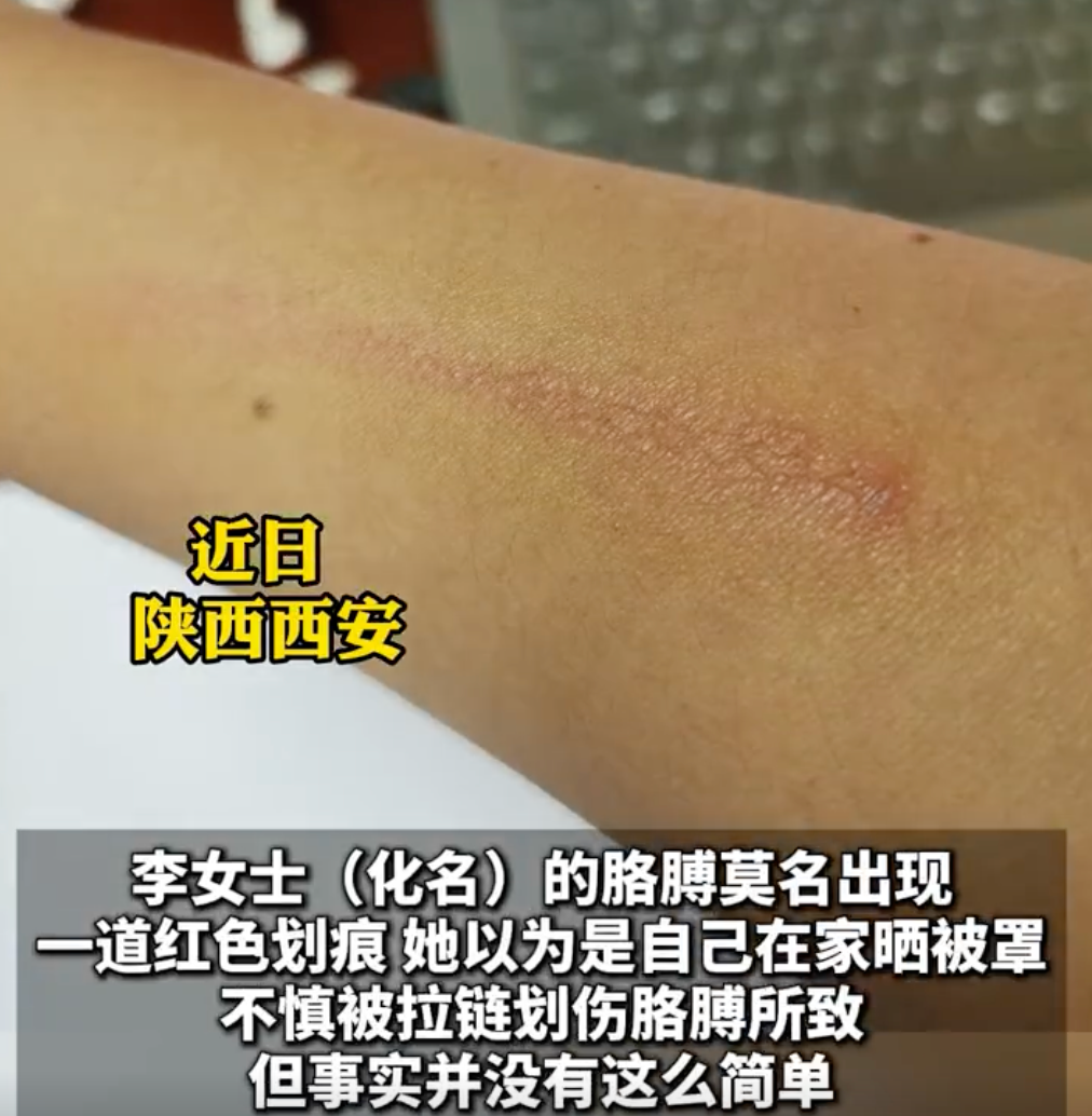 女子误认拉链划伤元凶竟是隐翅虫：伤害力堪比硫酸 - 创想鸟
