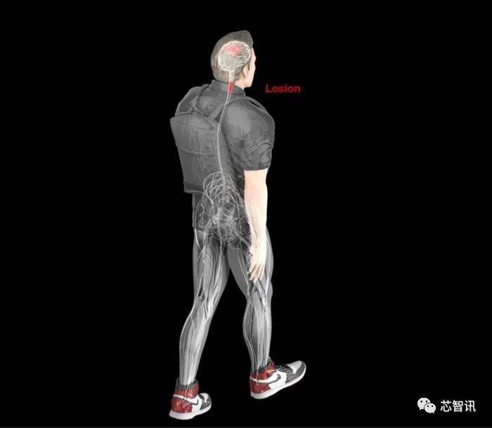 瘫痪10年的荷兰男子，靠植入脑机接口恢复行走！